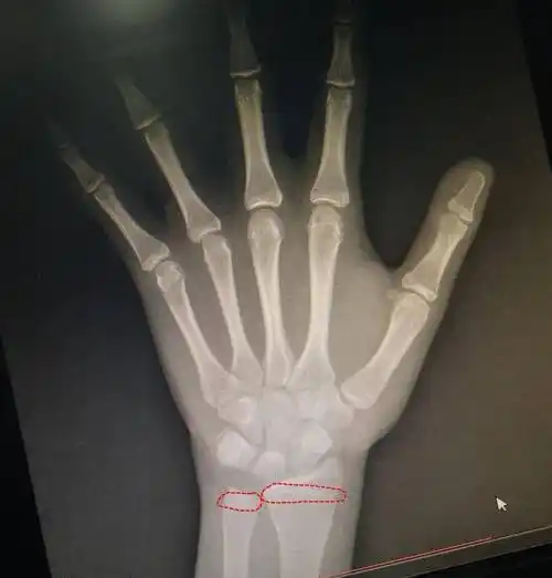 骨骺马上要闭合了结果骨龄片子拍出来一看看看还能长多高最近妈妈带着