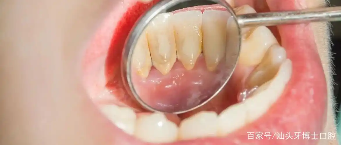 放大1000倍的牙齿到底有多脏?先呕了,密集恐惧症慎入!