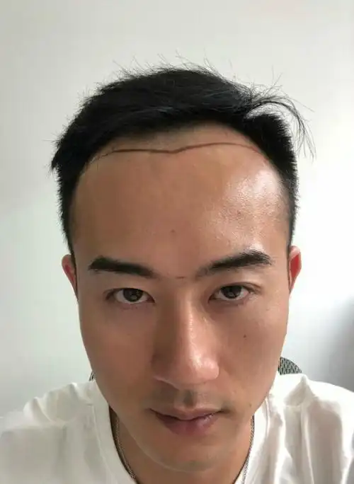 医生给我设计的美人尖发际线,看看合适我吗