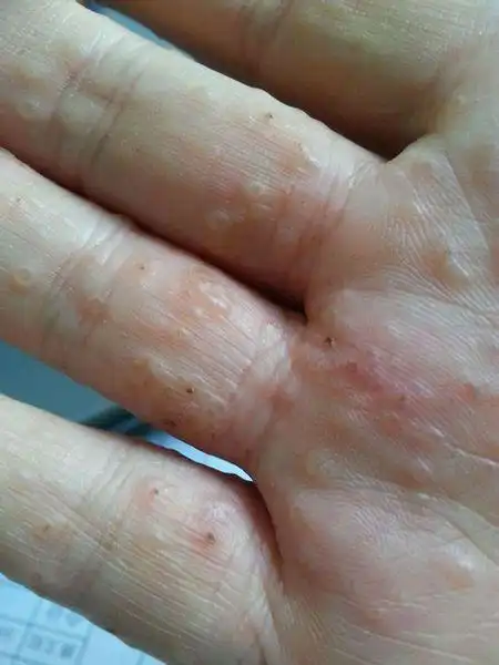 手上亮晶晶的小水疱,不痒不痛,反复发作,咋办?