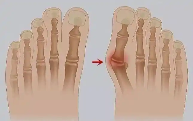 1717外翻是指大脚趾在第一跖趾关节处向外偏斜超过正常生理范围的
