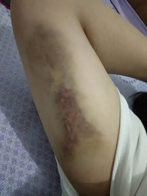 胳膊擦伤青一块紫一块的,用什么药膏擦能好的快