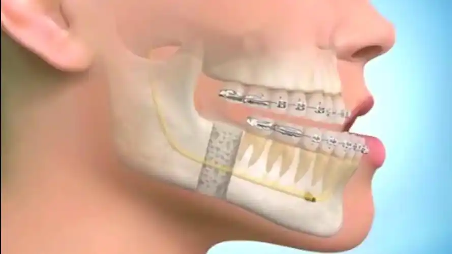 戽斗的正颌手术下颚升枝矢状截骨术