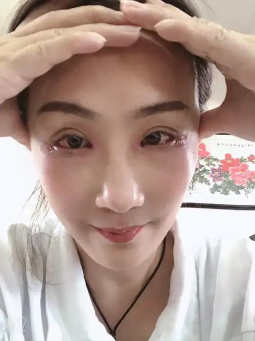 第一张是开内外眼角眼睑下至祛眼袋第14天的照片.