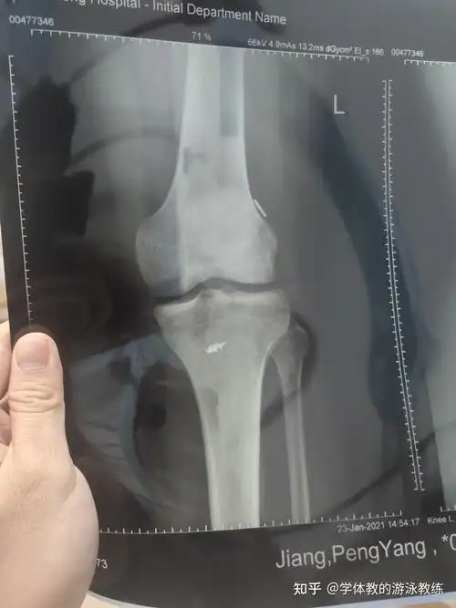 前交叉韧带断裂半月板损伤住院手术过程康复记录
