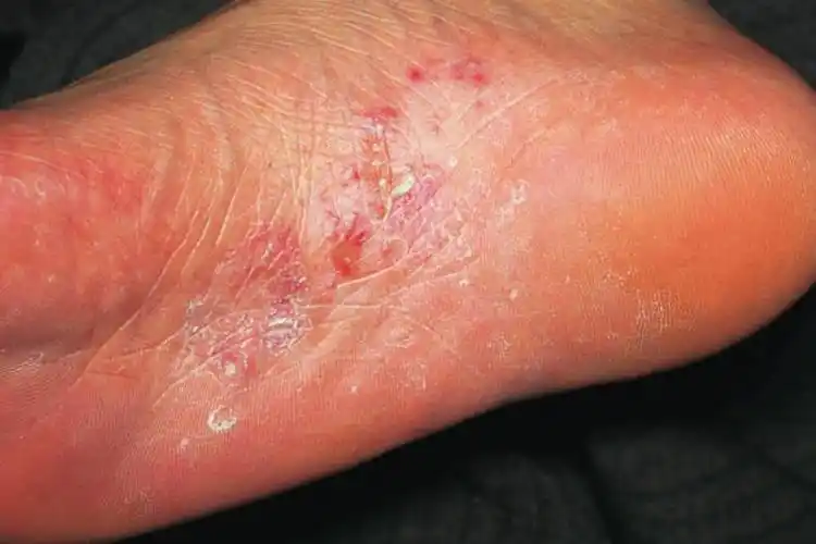 脚底鹅掌风症状图片_图文_文章_美咯_让您放心美!