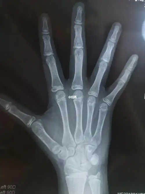 十二岁半男孩的骨龄,请懂的人帮我看一下