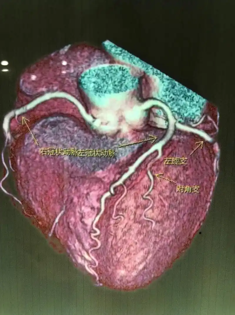 2右冠状动脉宏冠状动脉左旋支对角支15srpume rend - 抖音
