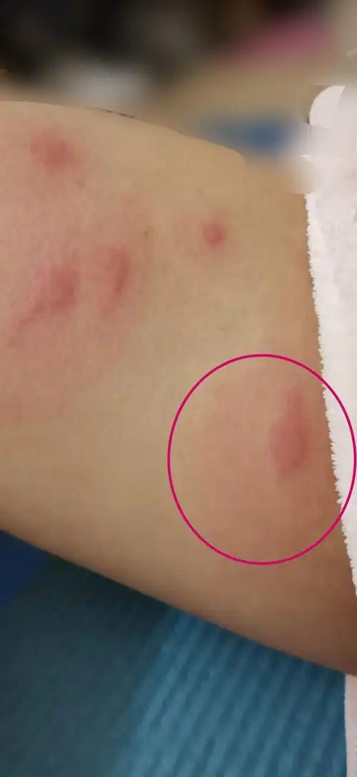 被跳蚤咬的全身都是包是什么样的感受! - 知乎