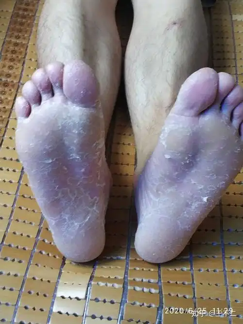 追光者一个掌趾角化症患者的独白