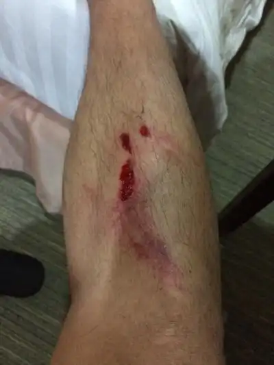 真实腿部受伤图片 (17)_有来医生
