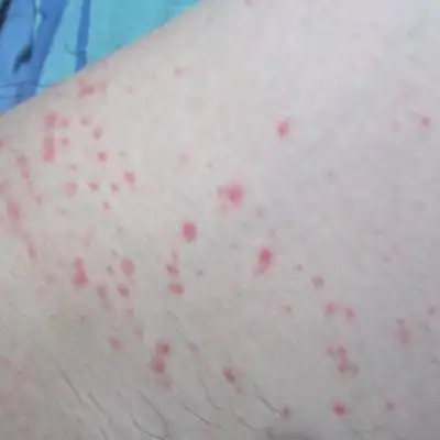 艾滋病大腿上红点图片 (44)