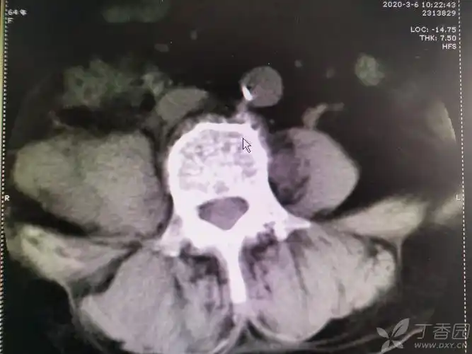 【求助】一例腰大肌脓肿病人的诊治(重点求助下脓肿致病菌的确定及抗