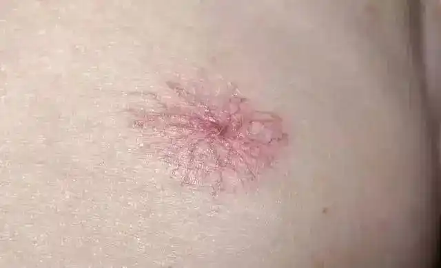 身体红痣症状竟是肝癌前兆(39岁男子查出肝癌晚期)(6)