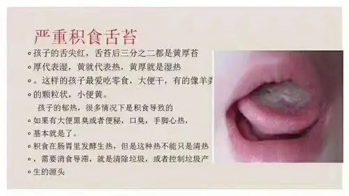 益生菌治疗地图舌