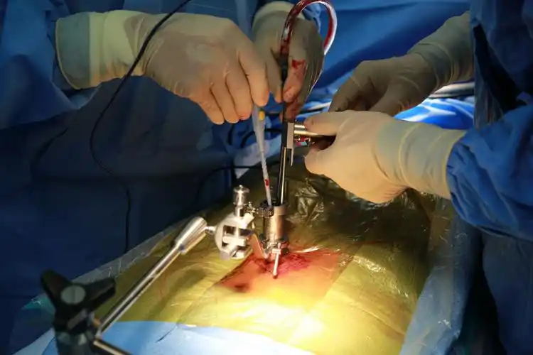 微创腰椎间盘手术之单纯减压 - 好大夫在线