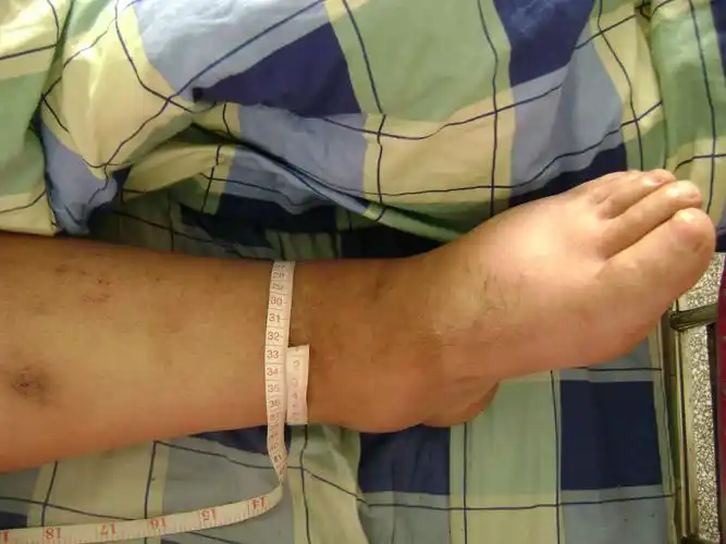 大家谁见过橡皮腿丝虫病这个像不像我没见过