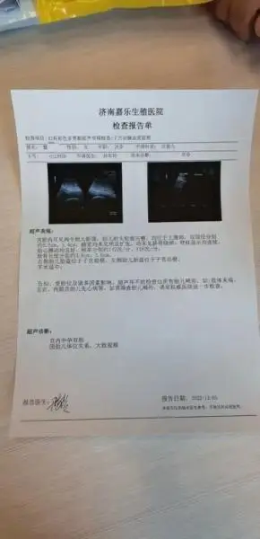 多囊体胖好孕难精准治疗怀双胎