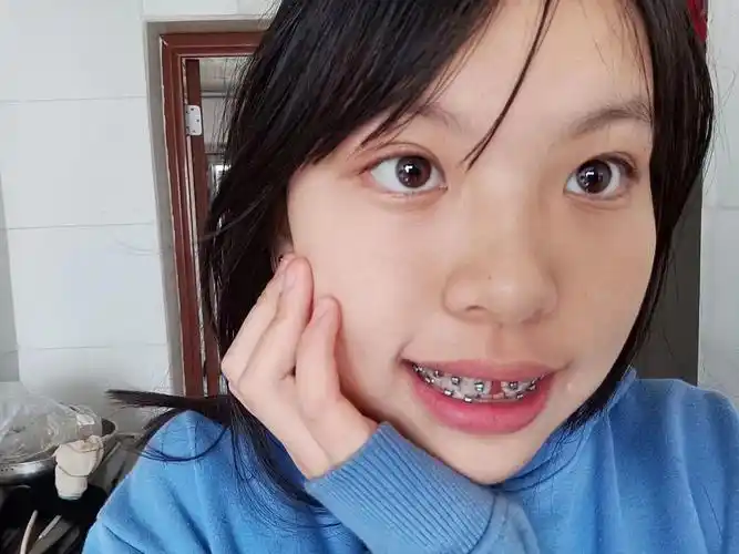 戴牙套四个月对比和整牙价格(全是原相机记录)