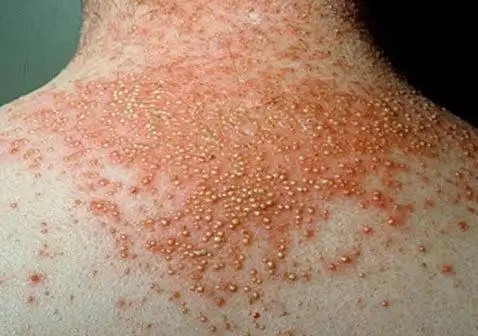 牛皮肤癣的症状图片:5种牛皮癣的症状和体征图片