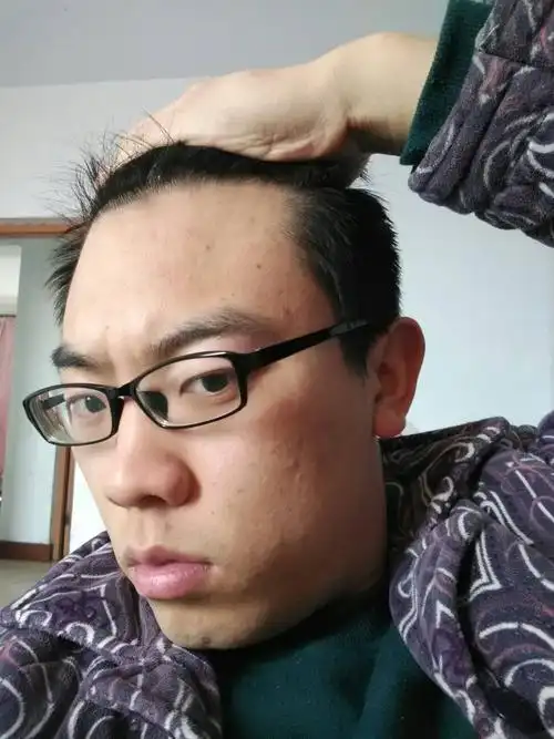 不知道继续发展会不会秃了.大家看下图吧.我常常熬夜.头发也