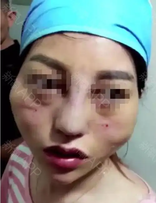 前两天在朋友圈看见几个触目惊心的整形案例!这是埋线的.