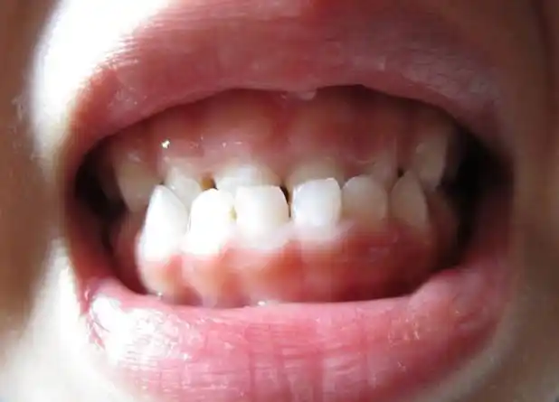 宝宝地包天,除了父母遗传,还可能是生活中这4个坏习惯引起的