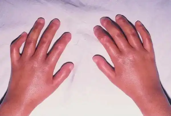 一起来了解——系统性硬化症_硬皮病_介绍_症状表现_检查_治疗方式