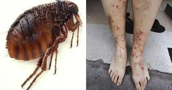 被跳蚤咬过后有疙瘩怎么治疗跳蚤咬过后的疙瘩照片