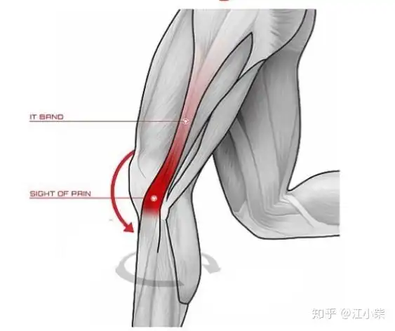 如何判断是否为髂胫束综合症附图