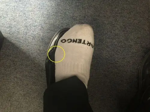 脚外侧骨头突出是怎么回事?严重吗?