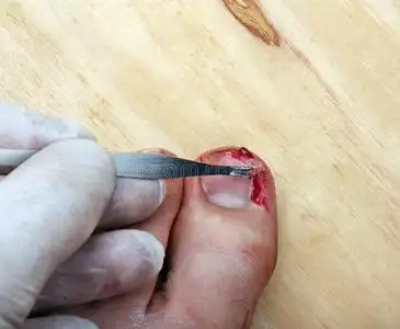 破裂出血的指甲照片