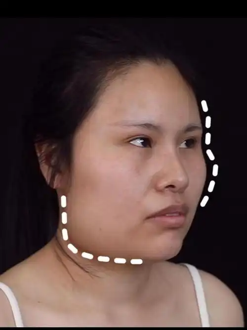 颧弓颧骨长曲线下颌角截骨术后即刻对比