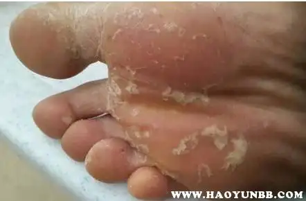 脚底死皮是因为脚部经常摩擦行成坏死的角质层,经过水浸泡后很容易