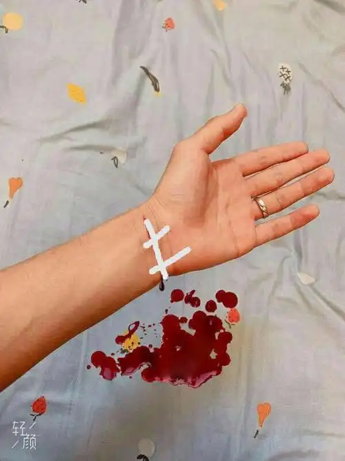 求大神p一个手腕流血包扎好的照片,在线等
