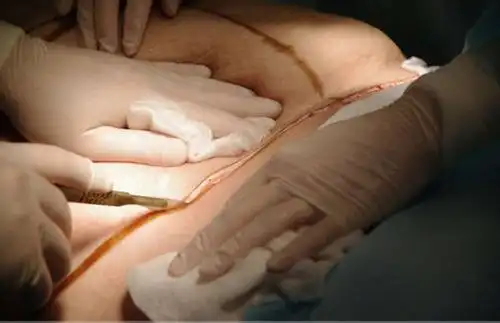 慎入恐怖的整形吸脂手术实拍全程