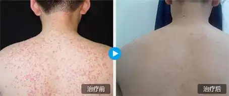 毛囊炎的常见症状有哪些?