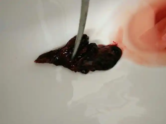 流出一块很大块的东西,是血块还是其他的,小产那天胎盘那些都流干净了