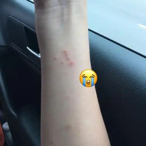 被螨虫咬怎么办