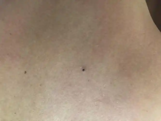 请问这种皮肤上的黑点是什么问题?_百度知道