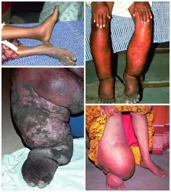 淋巴丝虫病(淋巴水肿的严重程度的范围)