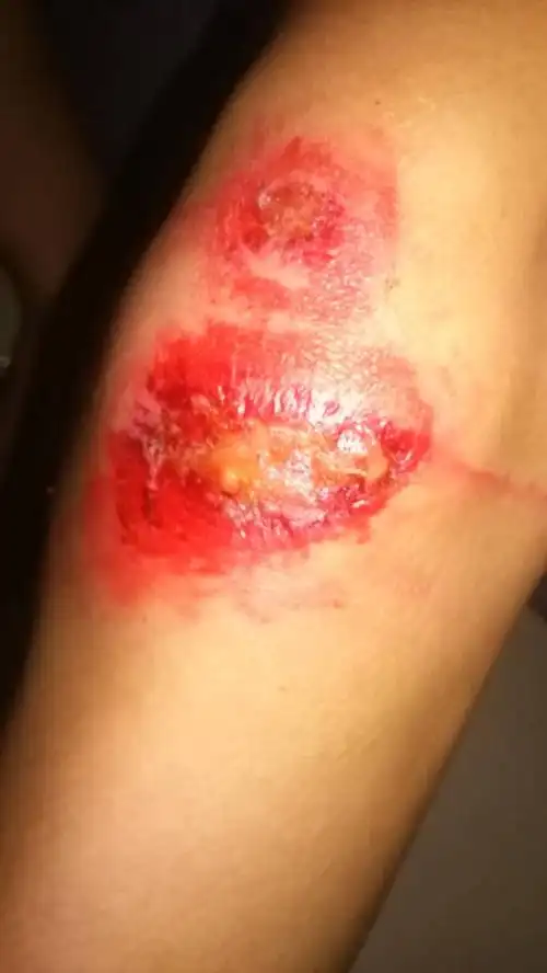 骑车膝盖倒地擦伤2天,化脓,用双痒水清洗了,还化脓,这种伤口怎么