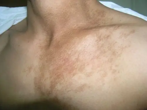 看图识病---公布答案色素性毛表皮痣 - 皮肤及性传播疾病讨论版