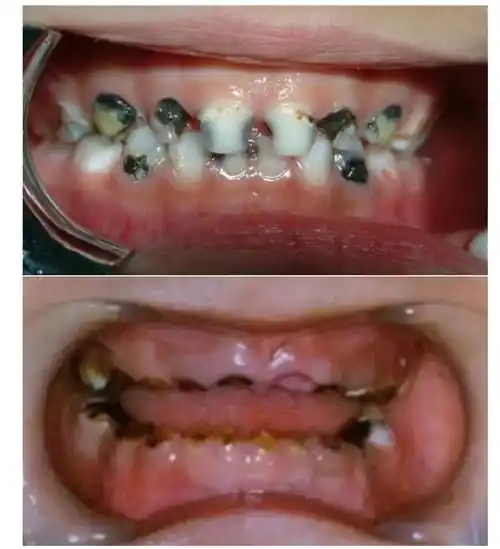 小孩蛀牙怎么办(5岁儿童烂牙到底要不要补)插图