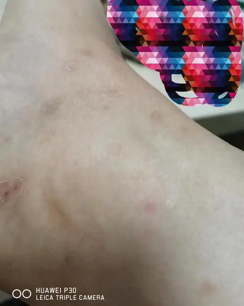 问下姐妹,脚上那种蚊虫叮咬后的疤留下的色素沉淀怎么去掉?