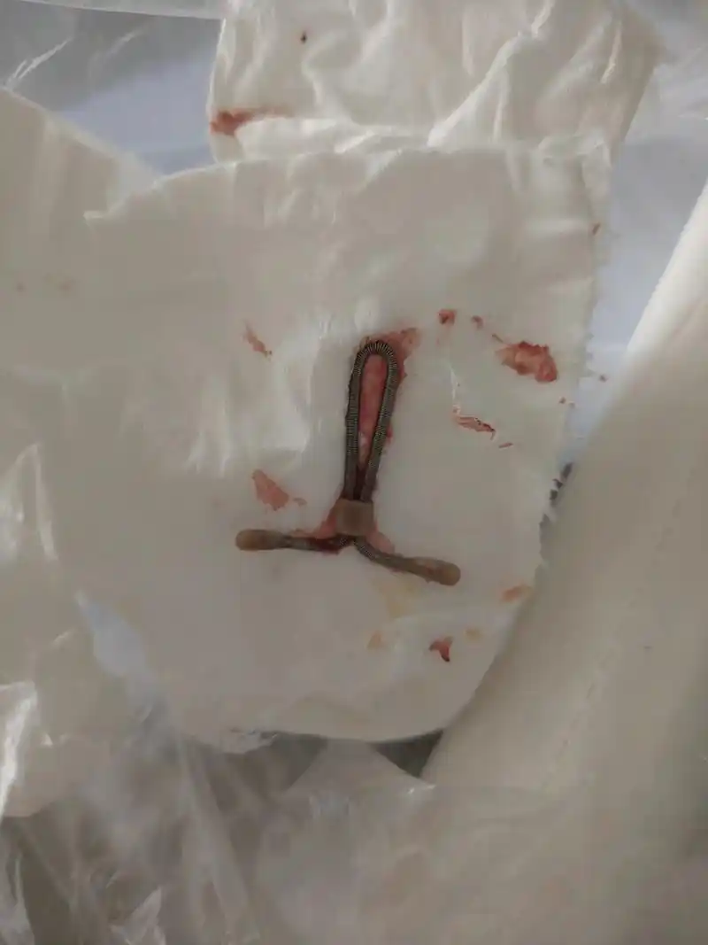 有一种疼叫取环的疼,真的要人半条命那种,无以言语的痛