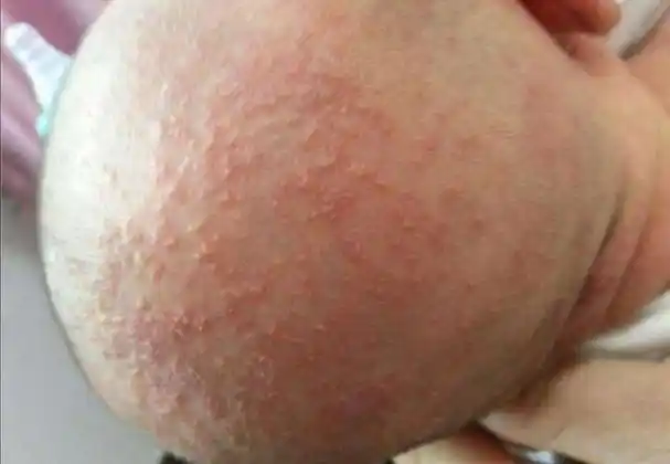 湿疹与痱子应该如何判断呢?