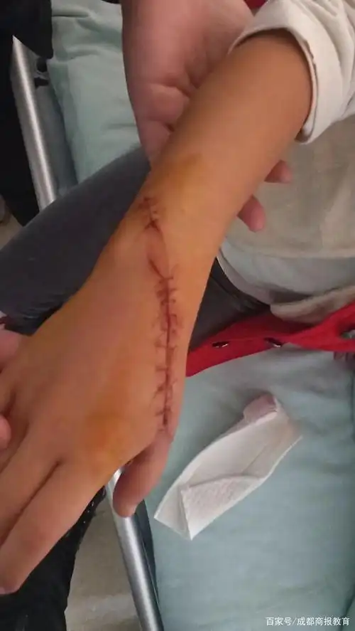 "伤口近20厘米",6岁女孩成都欢乐谷游玩受伤,谁该担责?