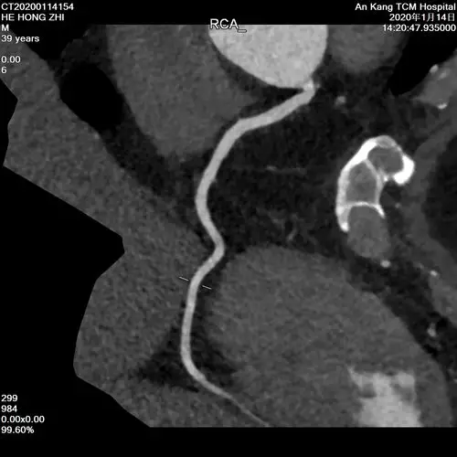 贺宏智的心脏冠脉ct成像