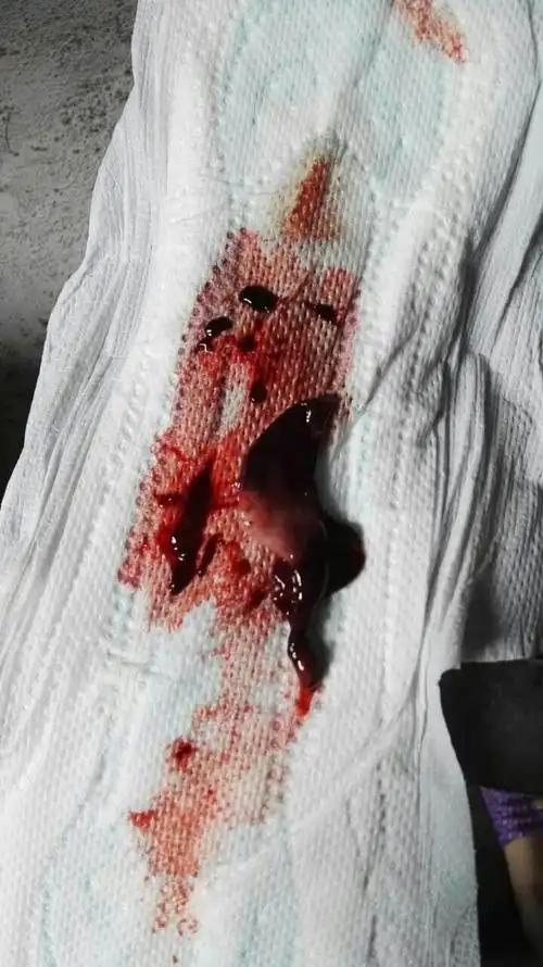 例假前三天,出现血块,是生化吗?